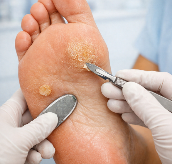 1 Corns & Calluses.png